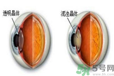 白內(nèi)障治療方法是什么？白內(nèi)障可以用什么藥物治療？