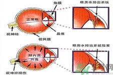 青光眼的發(fā)病因素是什么？青光眼的并發(fā)癥有哪些？
