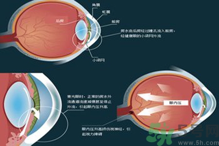 青光眼的高發(fā)人群有哪些？如何預防青光眼？