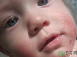 寶寶長(zhǎng)奶蘚怎么回事？寶寶長(zhǎng)奶蘚怎么辦？