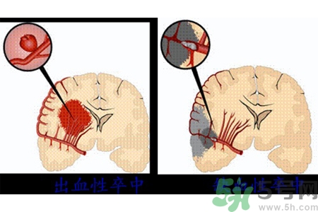 腦出血的發(fā)病因素是什么？腦出血的并發(fā)癥有哪些？