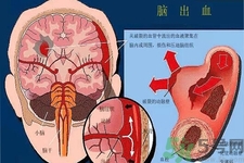 腦出血的發(fā)病因素是什么？腦出血的并發(fā)癥有哪些？