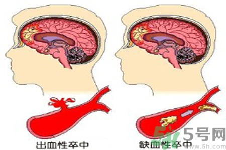 腦出血的治療方法是什么？腦出血可以用哪些藥物治療？