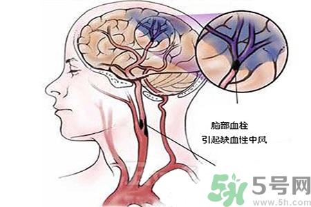 腦出血的治療方法是什么？腦出血可以用哪些藥物治療？