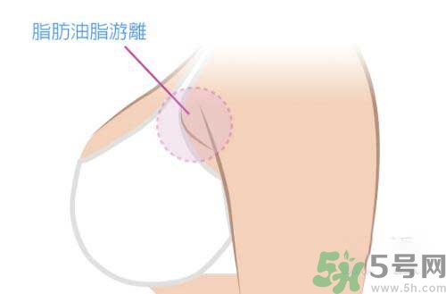 副乳是什么？副乳的危害