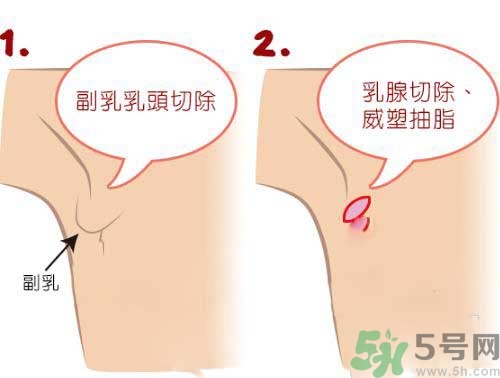 副乳是什么？副乳的危害