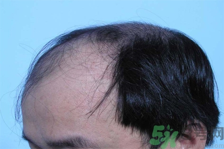 脫發(fā)的措施有什么？脫發(fā)的注意飲食有哪些？