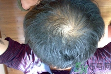 脫發(fā)的高發(fā)人群有哪些？如何預防脫發(fā)？