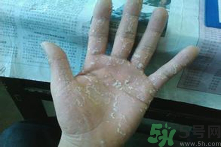 引起手足癬的主要原因？手足癬會引發(fā)什么疾病？