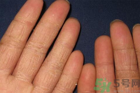 手足癬的治療方法？治療手足癬可以用什么藥？
