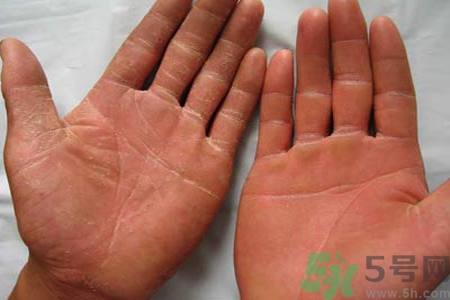 手足癬的治療方法？治療手足癬可以用什么藥？