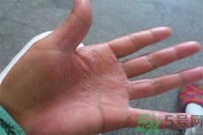 手足癬的易發(fā)人群有哪些？如何預(yù)防手足癬？