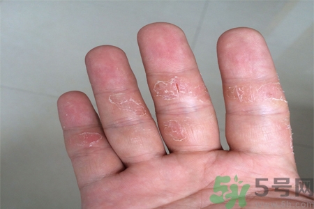 手足癬的易發(fā)人群有哪些？如何預(yù)防手足癬？