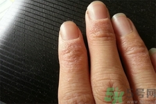 手足癬會(huì)傳染嗎？手足癬的傳播途徑有哪些？