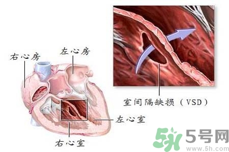 先天性心臟病是什么？先天性心臟病的癥狀有哪些？