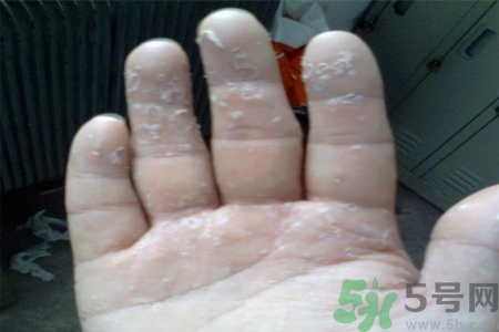 手足癬的易發(fā)人群有哪些？如何預(yù)防手足癬？