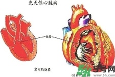 心臟病的癥狀是什么？心臟病的種類有哪些？