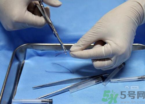 埋線減肥多少錢一次？埋線減肥的副作用