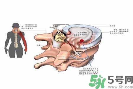為什么年輕人容易得頸椎病？頸椎病嚴(yán)重的癥狀有哪些？