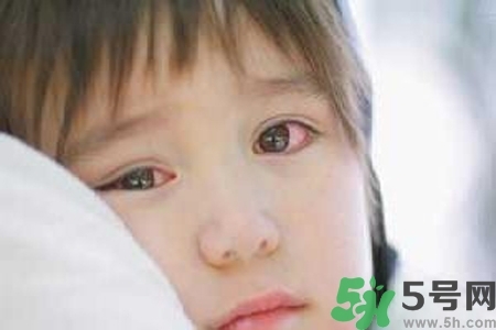 寶寶為什么會(huì)感染紅眼??？寶寶患紅眼病如何治療？