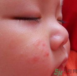 寶寶長(zhǎng)蘚是怎么回事？寶寶長(zhǎng)蘚怎么辦？