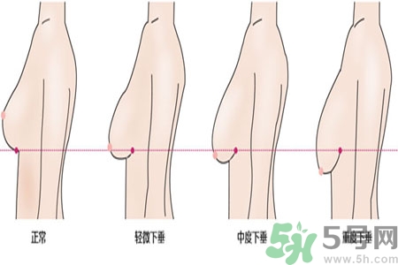 ?女性乳房下垂的原因是什么？女性乳房下垂的分類有哪些？