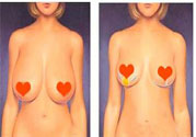 ?女性乳房下垂的原因是什么？女性乳房下垂的分類有哪些？