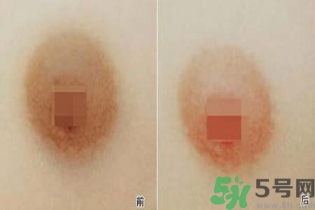 乳頭發(fā)黑怎么辦？怎么樣可以使乳頭變白？