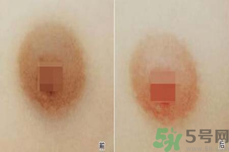 乳頭發(fā)黑是怎么回事？乳頭發(fā)黑是什么原因？