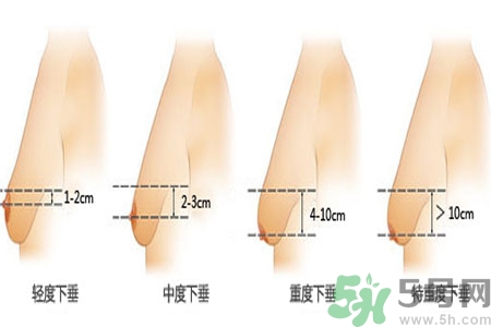 胸部松弛的原因是什么？胸部松弛該怎么辦？