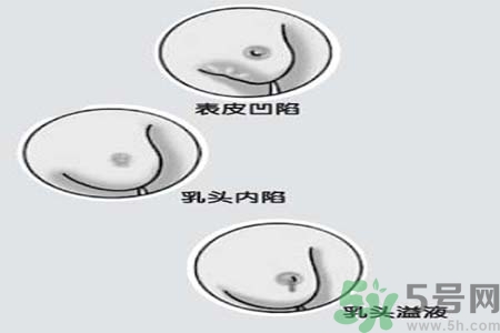 乳頭內(nèi)陷怎么回事？乳頭內(nèi)陷的原因是什么？