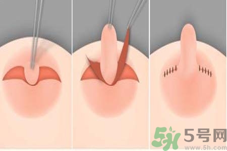 乳頭內(nèi)陷怎么回事？乳頭內(nèi)陷的原因是什么？