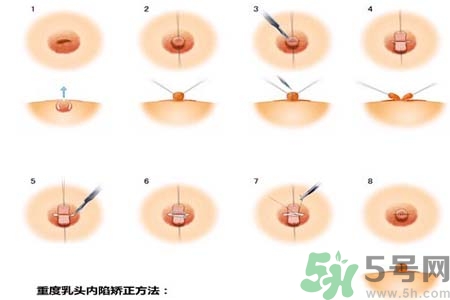 乳頭內(nèi)陷怎么回事？乳頭內(nèi)陷的原因是什么？