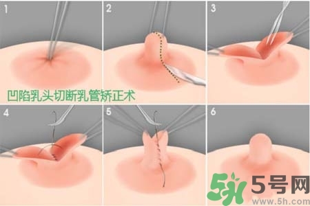 乳頭內(nèi)陷怎么辦？乳頭內(nèi)陷的癥狀有哪些？