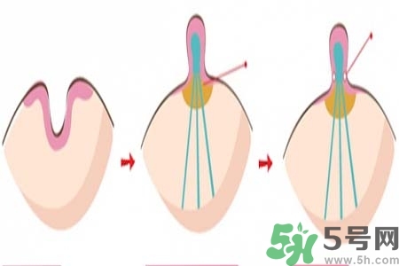 乳頭內(nèi)陷怎么辦？乳頭內(nèi)陷的癥狀有哪些？