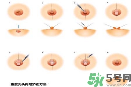 乳頭內(nèi)陷怎么辦？乳頭內(nèi)陷的癥狀有哪些？