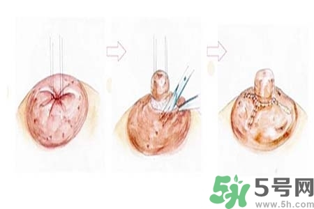 乳頭內(nèi)陷怎么辦？乳頭內(nèi)陷的癥狀有哪些？