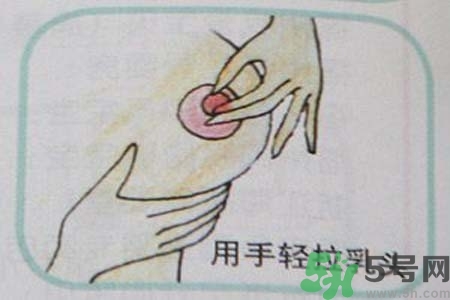 乳頭內(nèi)陷怎么辦？乳頭內(nèi)陷的癥狀有哪些？