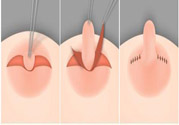 乳頭內(nèi)陷怎么辦？乳頭內(nèi)陷的癥狀有哪些？