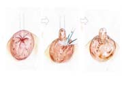 乳頭內(nèi)陷矯正需注意什么？乳頭內(nèi)陷如何預(yù)防？