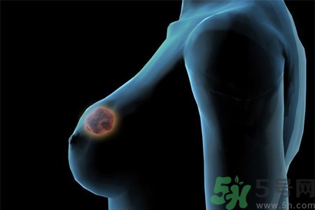 乳房屋硬塊有疼痛感怎么回事？乳房屋硬塊有疼痛感怎么辦？