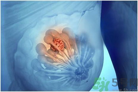 乳房屋硬塊有疼痛感怎么回事？乳房屋硬塊有疼痛感怎么辦？