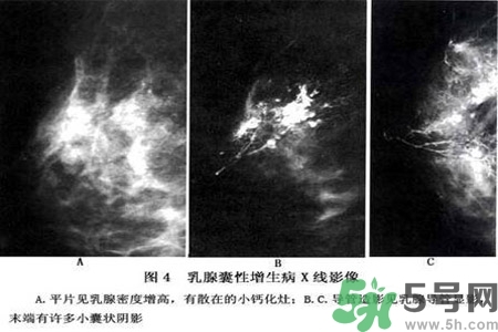 產(chǎn)生乳腺增生鈣化的病因是什么？乳腺增生怎樣治療？