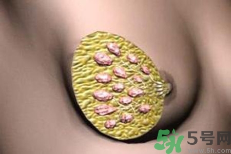 乳腺增生鈣化是什么？乳腺鈣化的癥狀有哪些？