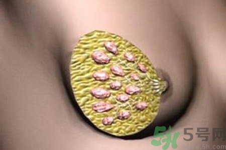產(chǎn)生乳腺增生鈣化的病因是什么？乳腺增生怎樣治療？