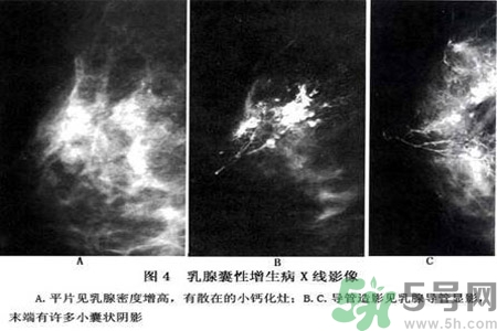 乳腺增生鈣化是什么？乳腺鈣化的癥狀有哪些？