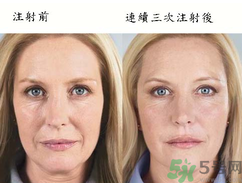 3D液態(tài)拉皮多少錢？3D液態(tài)拉皮后多久見效？