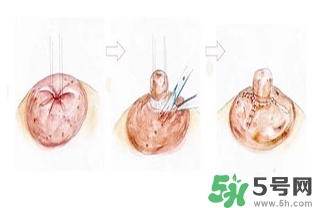 乳頭內(nèi)陷怎么矯正？乳頭內(nèi)陷矯正方法是什么？