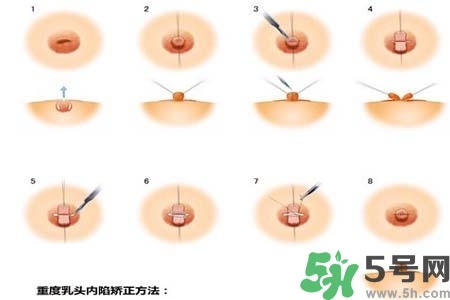 乳頭內(nèi)陷怎么矯正？乳頭內(nèi)陷矯正方法是什么？