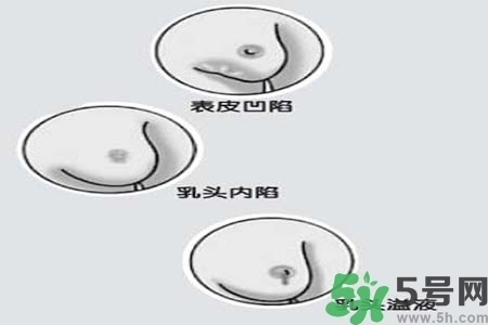 乳頭內(nèi)陷怎么矯正？乳頭內(nèi)陷矯正方法是什么？